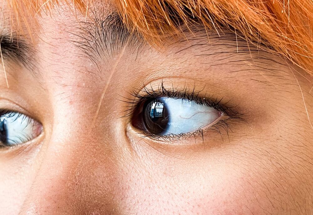  a girl have a disease name is blue sclera